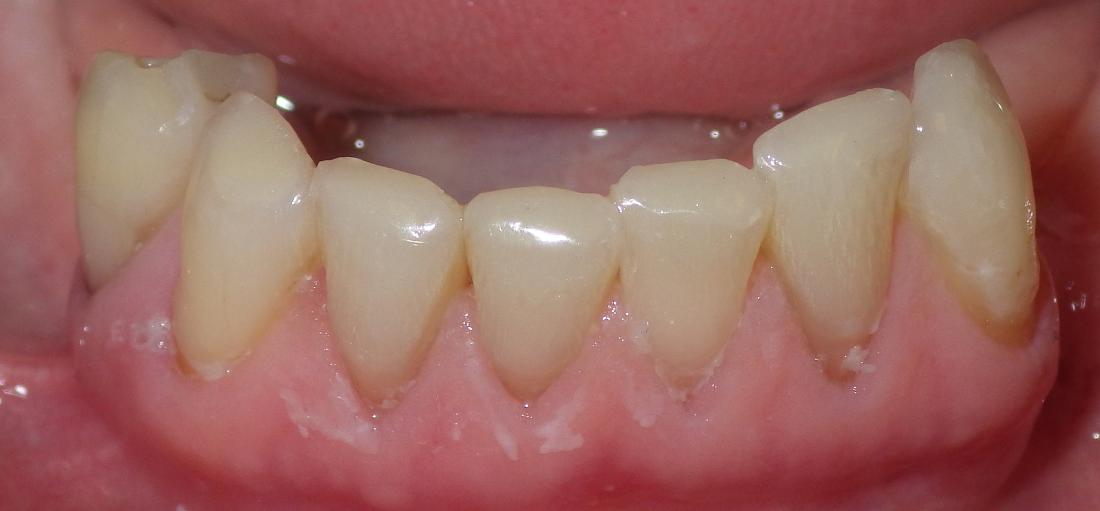 dental bonding for worn lower teeth | Dentist Duxbury MA