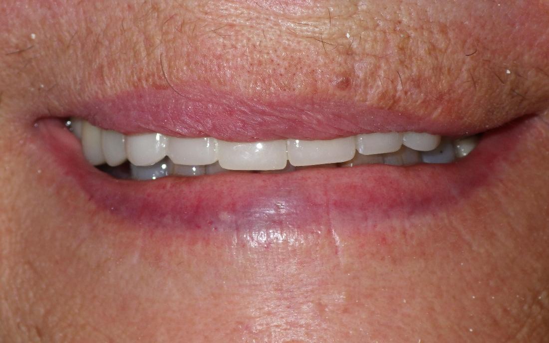 Porcelain crowns used on discolored teeth | Dentist Duxbury MA