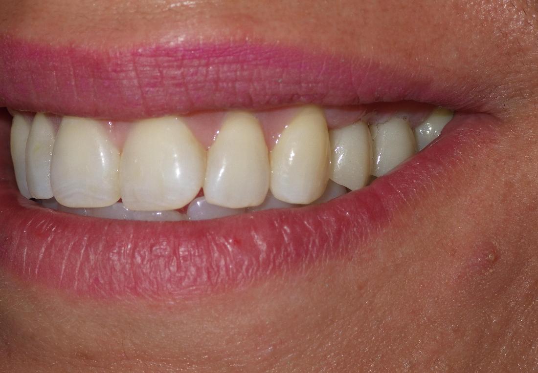 Dental implants used to replace missing teeth | Dentist Duxbury MA