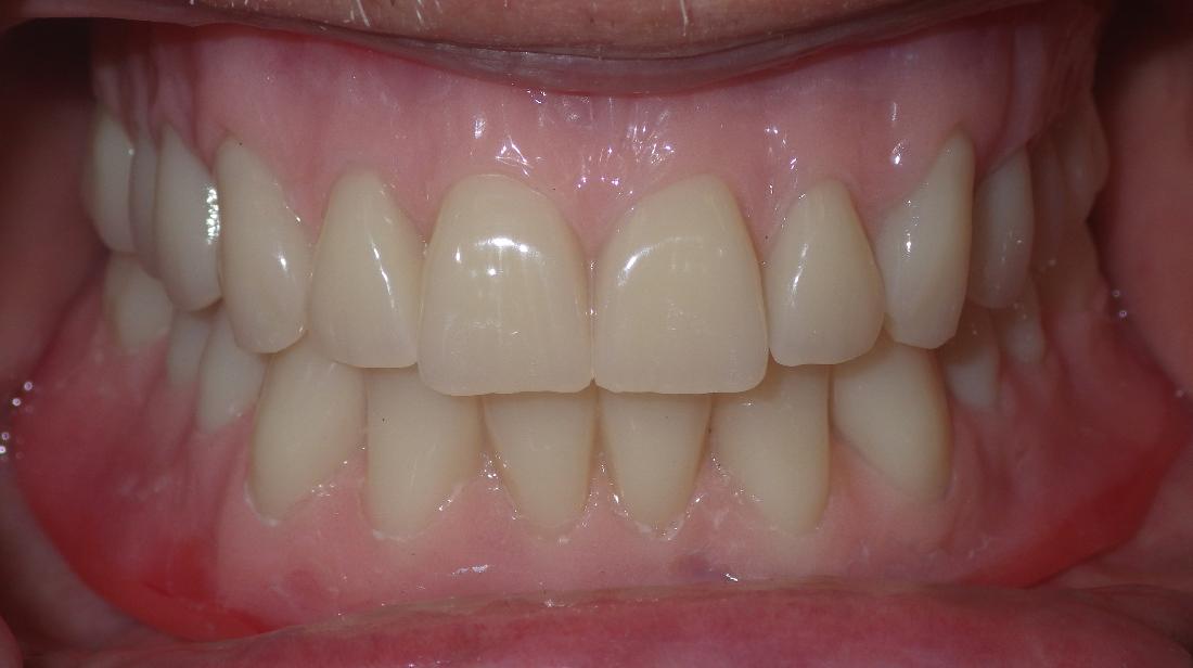 Dental implant supported dentures | Dentist Duxbury MA