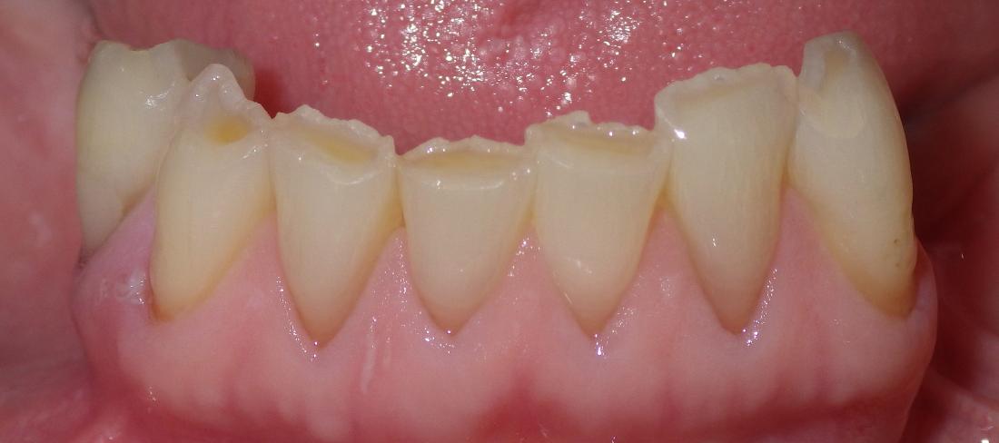 worn lower front teeth | Dentist Duxbury MA