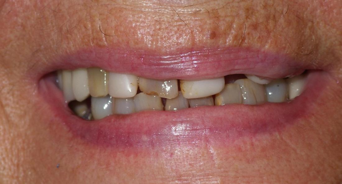 Broken and discolored teeth | Dentist Duxbury MA