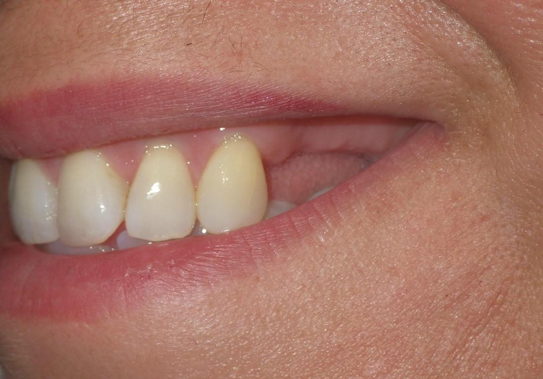 Woman missing back upper teeth | Dentist Duxbury MA