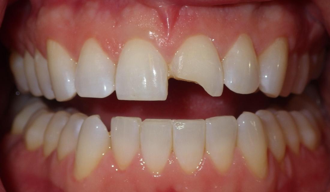 Chipped front tooth | Dentist Duxbury MA