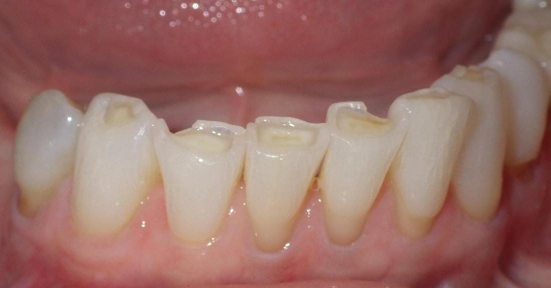 Worn down bottom teeth | dental clinic in Duxbury
