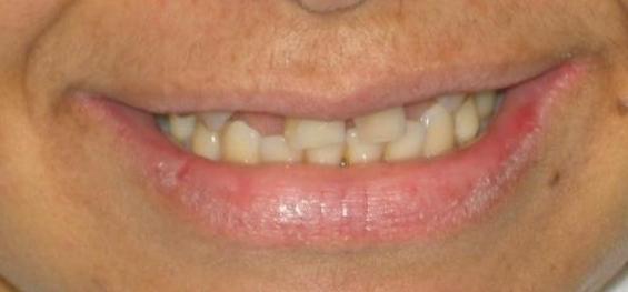 Multiple worn teeth | Dentist Duxbury MA