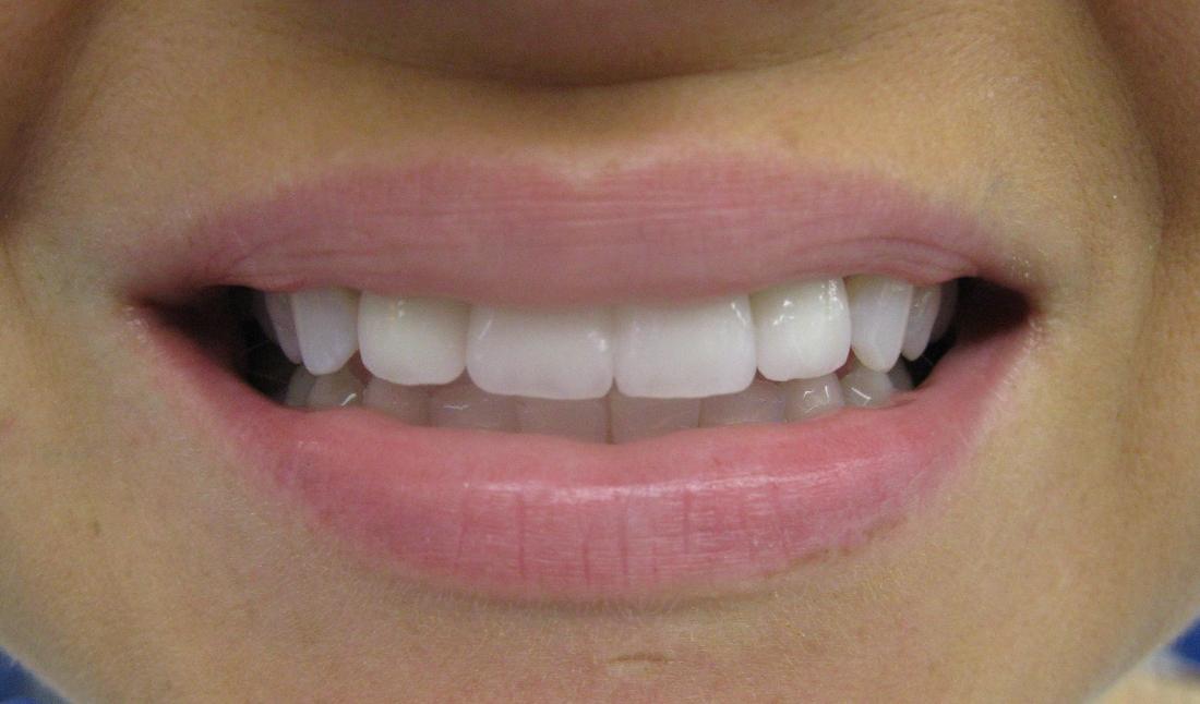 Dental veneers used on front teeth | Duxbury MA Dentist