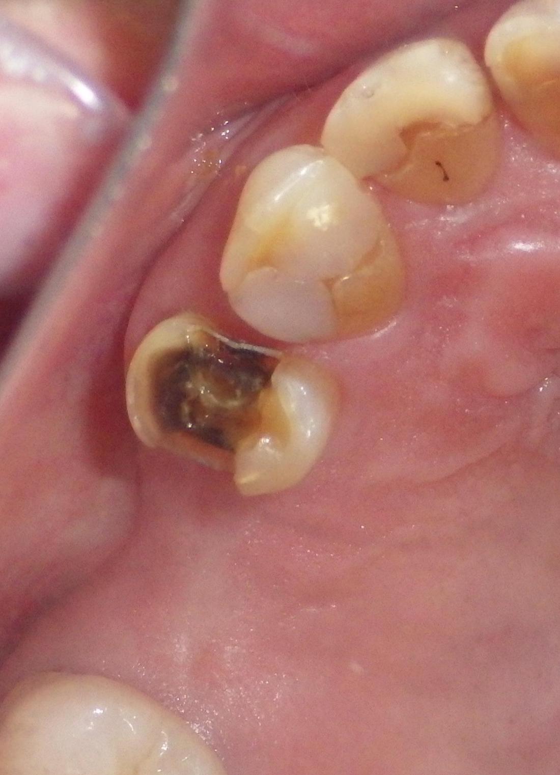 Broken tooth | Dentist Duxbury MA