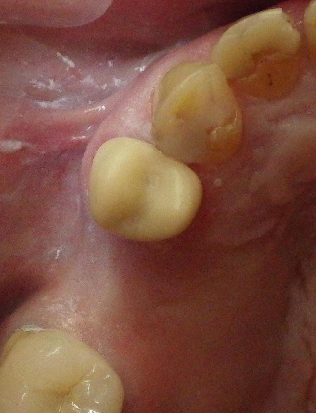 Ceramic crown used to correct broken tooth | Dentist Duxbury MA