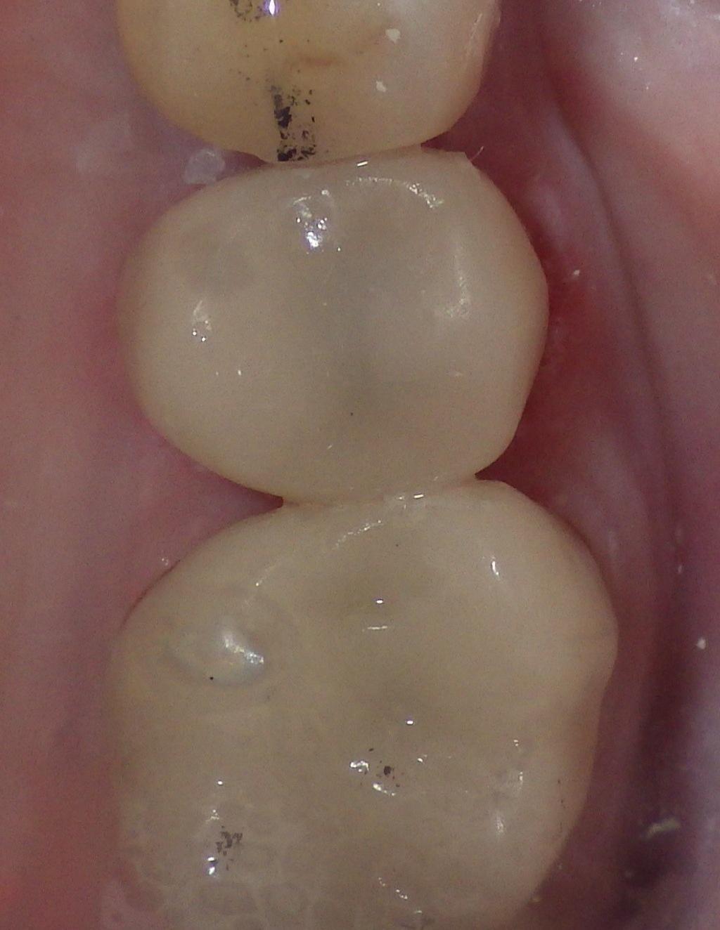 Dental crown on broken front tooth | Dentist Duxbury MA