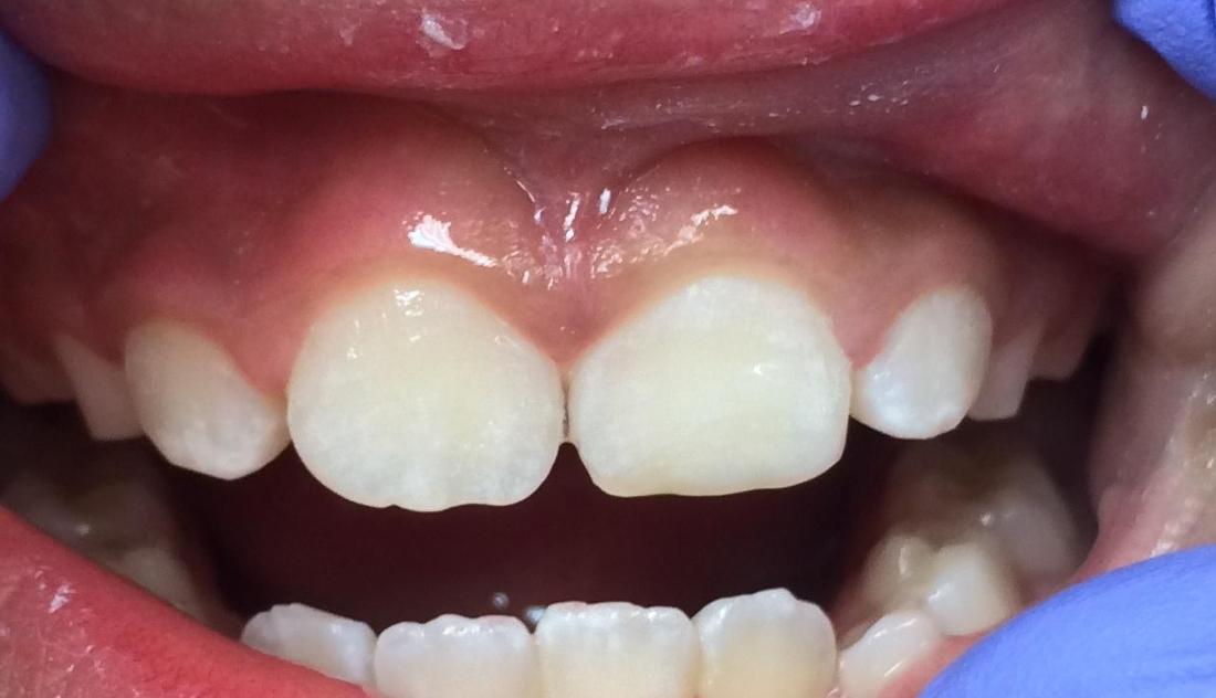 Dental bonding on chipped teeth | Dentist Duxbury MA