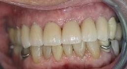 Veneers and whitening used for discolored teeth