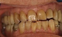 Discolored upper teeth | Dentist Duxbury MA