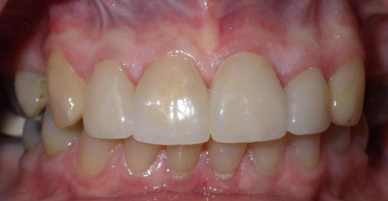 New crowns on upper front teeth | Dentist Duxbury MA