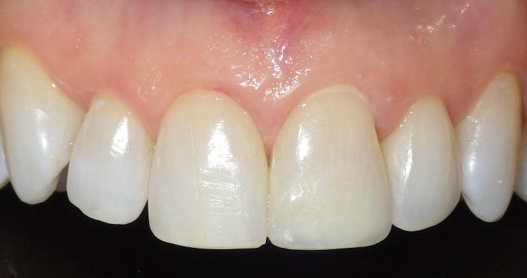 Dental bonding used for front teeth | Dentist Duxbury MA