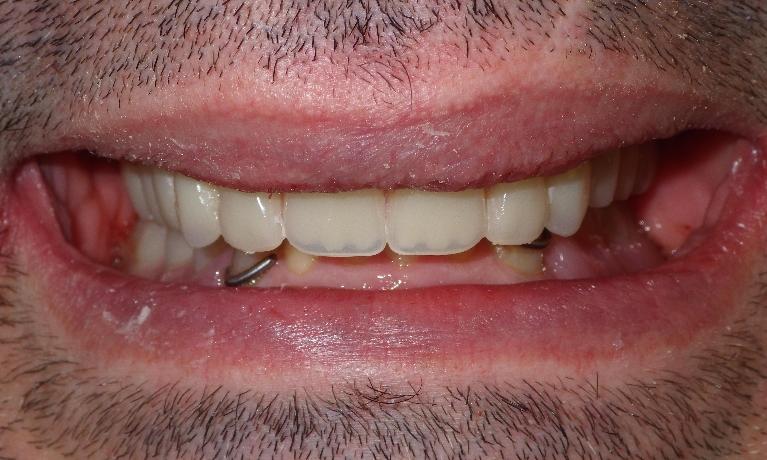 Implant supported dentures | dentist Duxbury MA