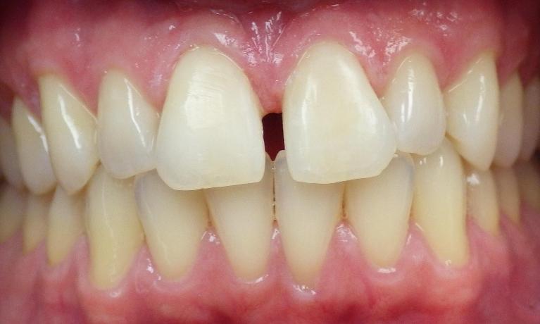 Dental bonding used to dark spots on front teeth
