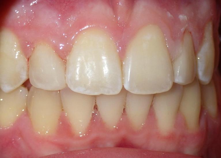 Composite bonding used to correct incisor | Dentist Duxbury MA