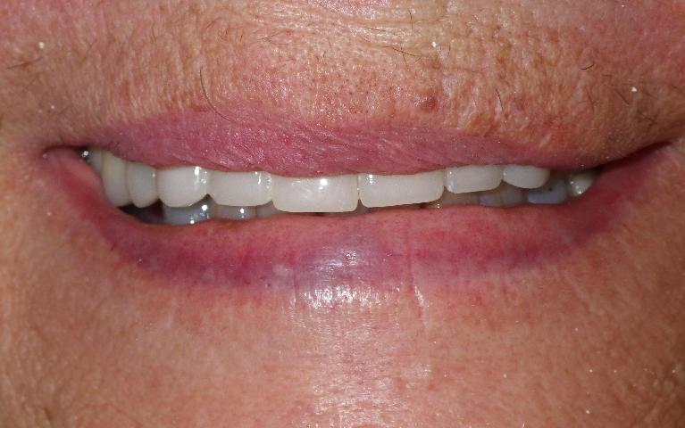 Cosmetic-Smile-Makeover-In-Progress-with-Temporary-Crowns-After-Image
