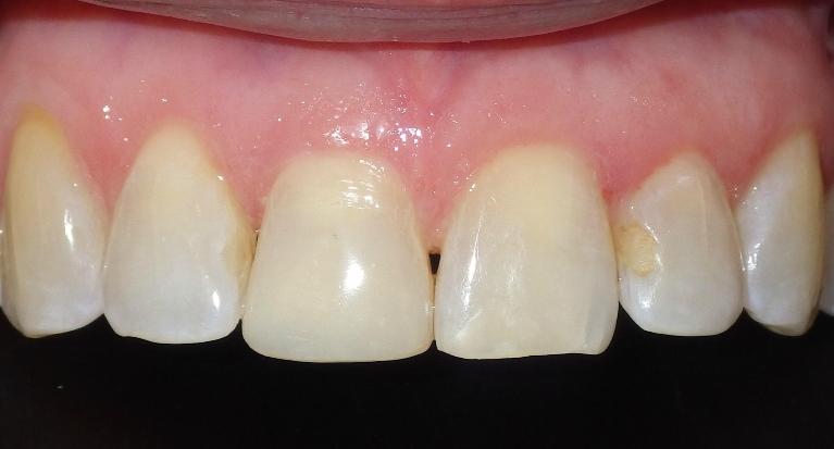Cosmetic bonding to correct chipped front tooth