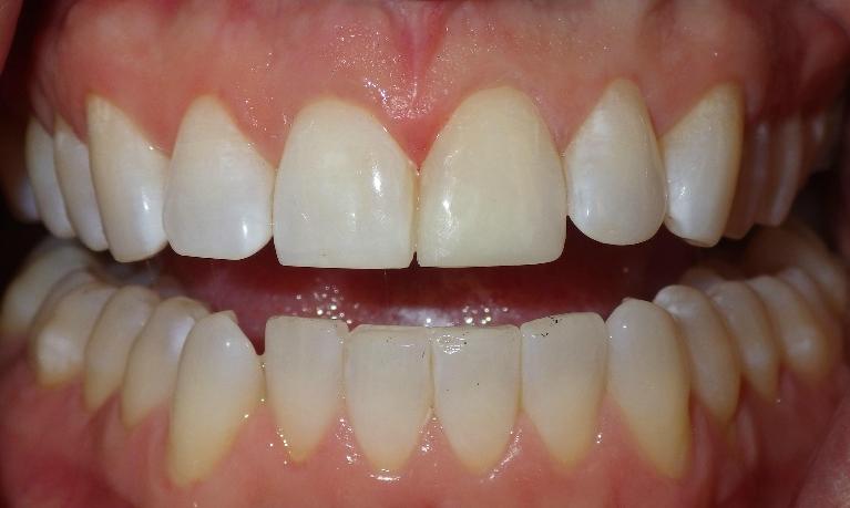 Cosmetic bonding to correct front tooth | Duxbury Dentist
