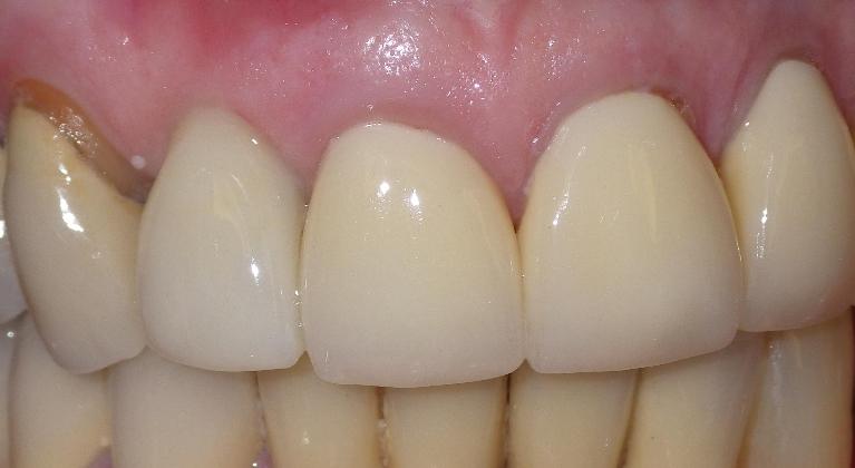 Dental implant to replace fractured tooth | Dentist Duxbury MA