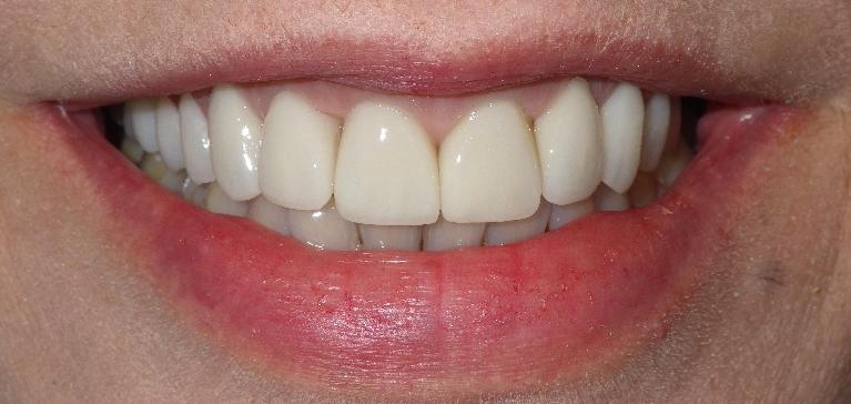 Dental crowns to correct discolored teeth | Duxbury MA Dentist