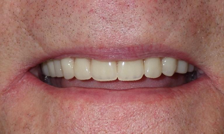 Implant-supported dentures | Dentist Duxbury MA