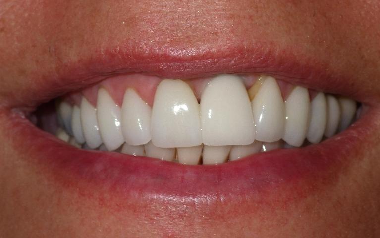 Dental implant on front tooth | Dentist Duxbury MA