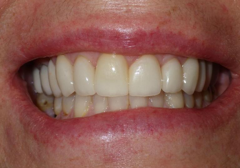 Ceramic crowns on front teeth | Duxbury MA Dentist