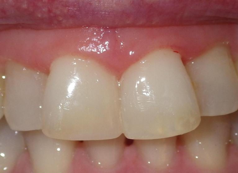 Composite bonding used to fix chipped teeth | Dentist Duxbury MA