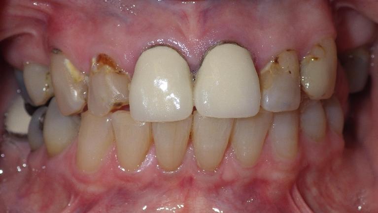 Discolored and cavity filled teeth | Dentist Duxbury MA