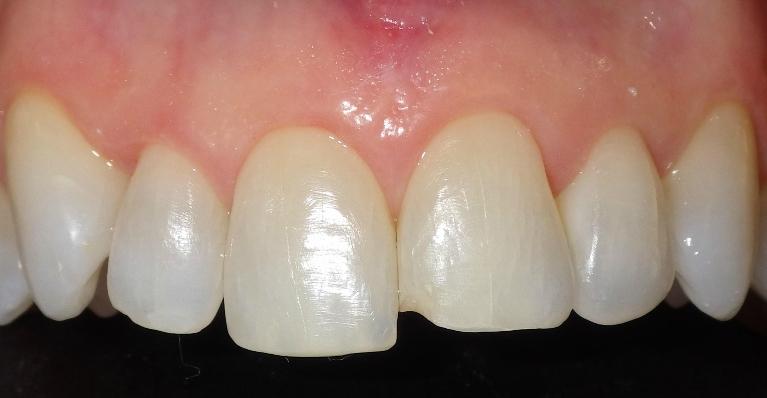 Front teeth are different sizes | Dentist Duxbury MA