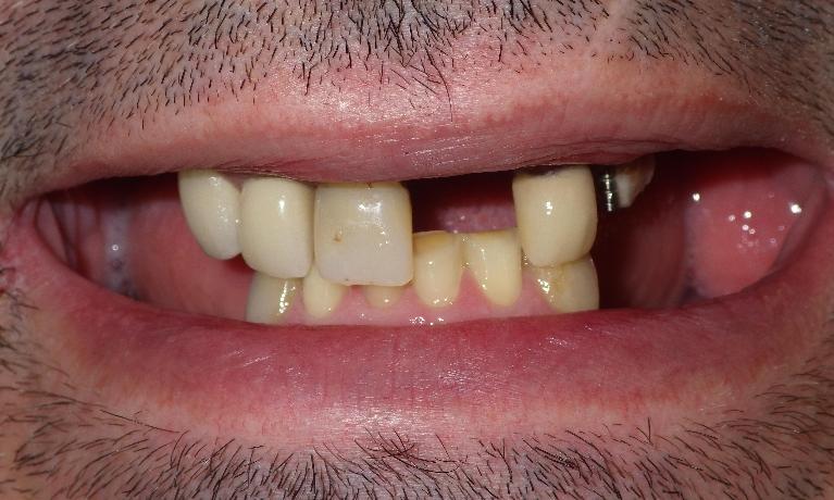 Missing upper teeth | Dentist Duxbury MA