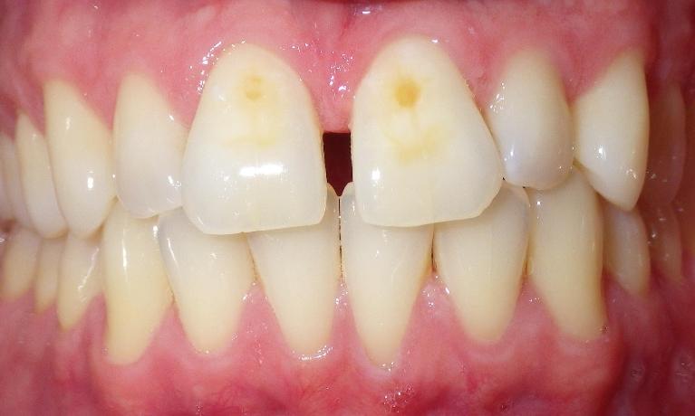 Dark spots on front teeth | Dentist Duxbury MA