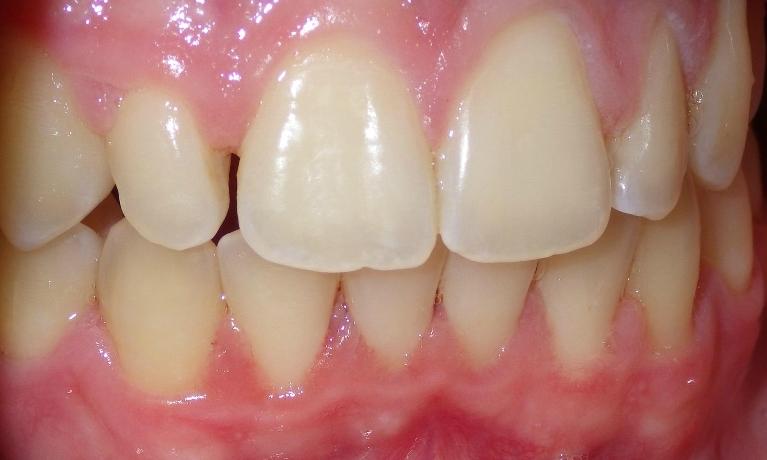 Small lateral incisor | Dentist Duxbury MA