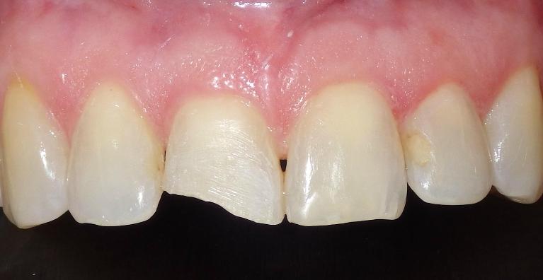 Chipped front tooth | Dentist Duxbury MA
