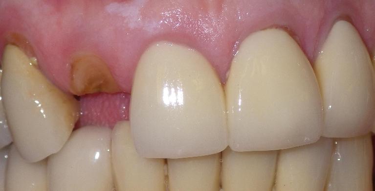 Tooth fracture at gum line | Dentist Duxbury MA