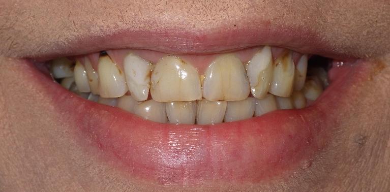 Discolored and cracked teeth | Dentist Duxbury MA