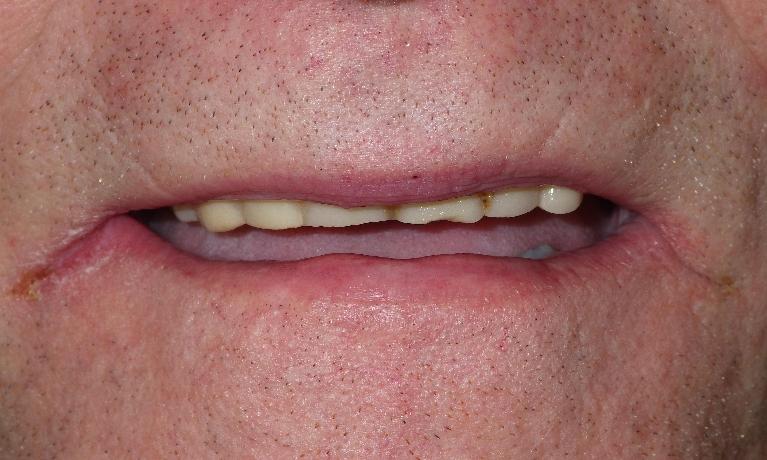 Multiple broken down teeth | Dentist Duxbury MA