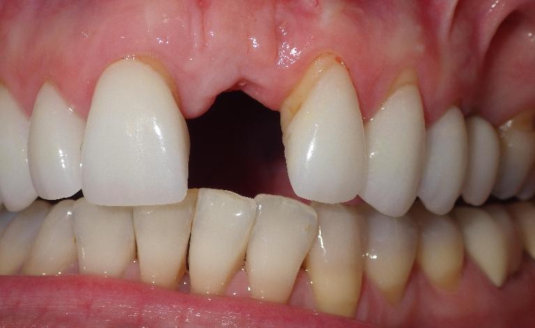 Missing front tooth | Dentist Duxbury MA