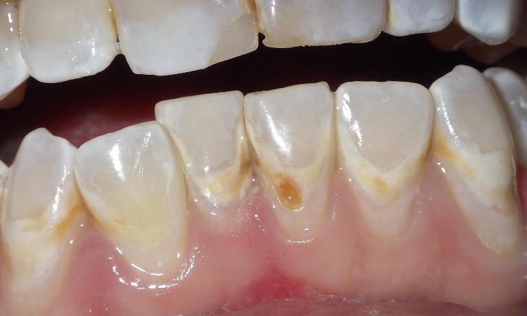 Small cavities near gumline | Dentist Duxbury MA