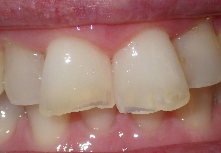 Chipped front teeth | Dentist Duxbury MA