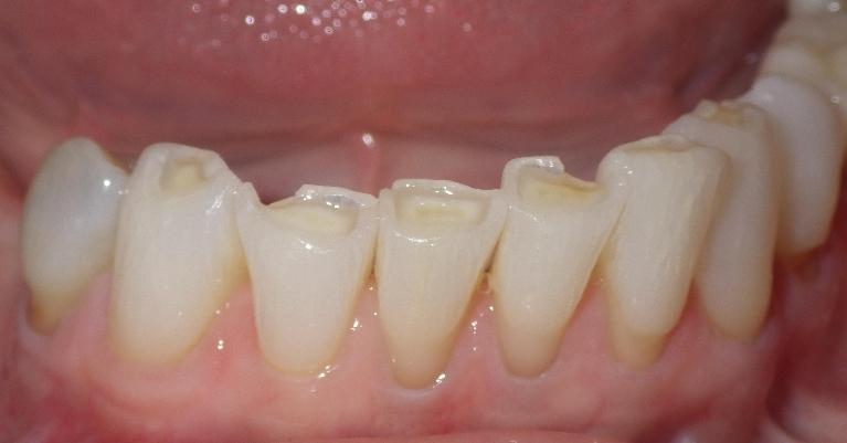 Worn down bottom teeth | dental clinic in Duxbury