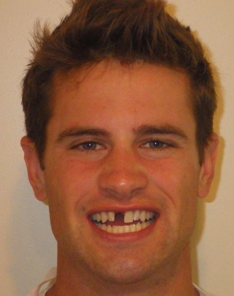 Missing front tooth | Dentist Duxbury MA
