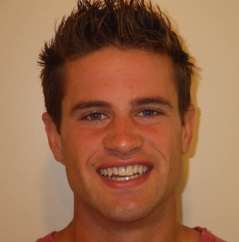 Dental implant to replace missing front tooth | Dentist Duxbury MA