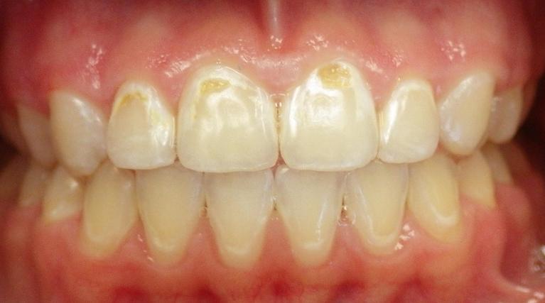 Small cavities and white spots | Dentist Duxbury MA