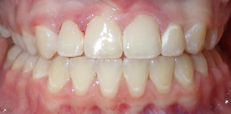 Composite fillings and bonding used to correct front teeth | Dentist Duxbury MA