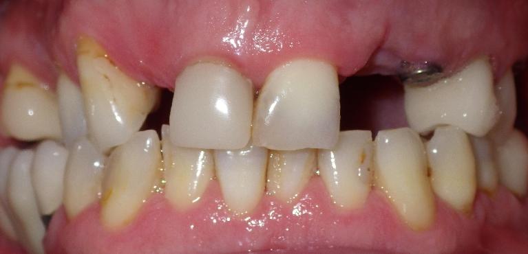 missing top teeth | Center for Progressive Dentistry