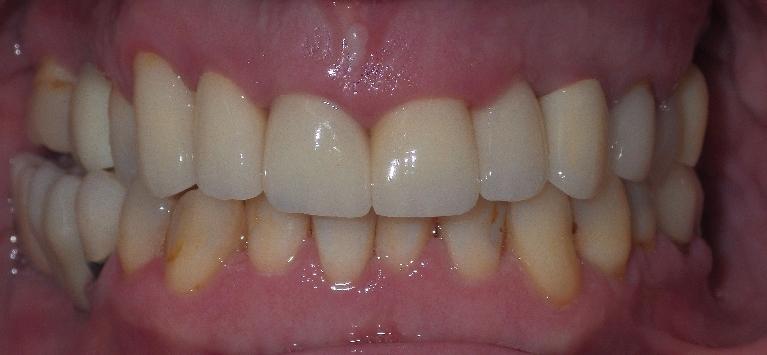 Dental implants to replace missing teeth | Dentist Duxbury MA